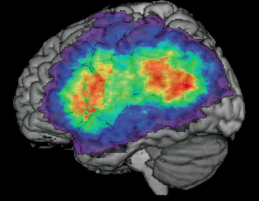 brain symptom mapping image